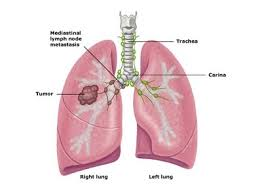 Illustration for article titled Obat Penyakit Paru Paru Alami